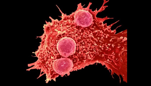 Sampel Sel Kanker Tunggal Dapat Meningkatkan Pengobatan Khusus